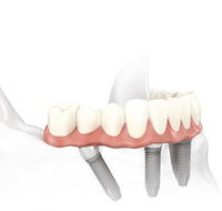 Specialist Oral Surgery - Dentist in Melbourne